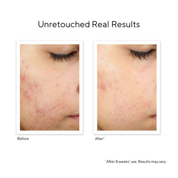 Murad InvisiScar Resurfacing Treatment 15ml - Image 2